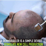 Dermaroller